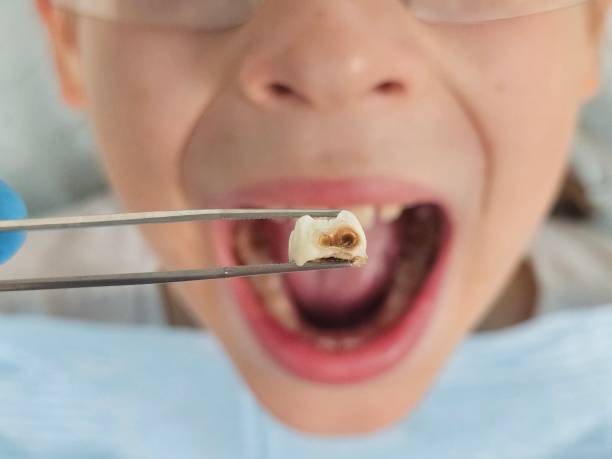 Best Emergency Wisdom Tooth Extraction in Sandstone, MN